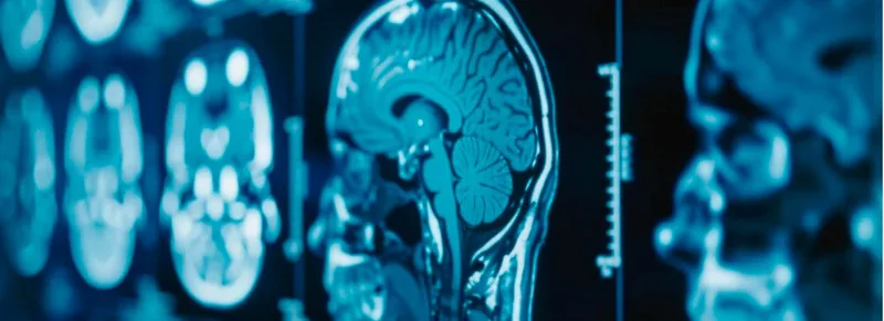 Sequência de imagens de ressonância magnética do cérebro em investigação diagnóstica